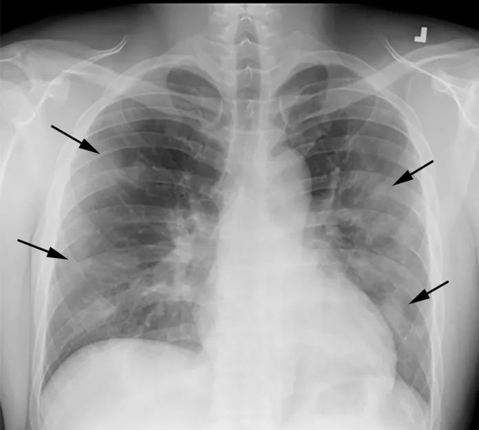 Osaka Metropolitan University Develops AI Tool for Non-Invasive Lung Function Assessment