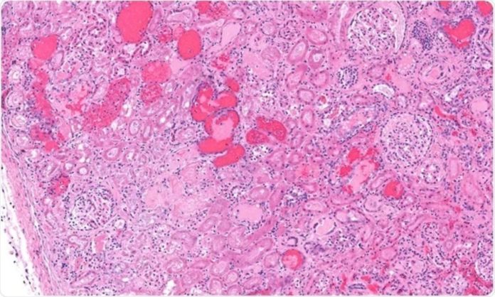 Italy Reports 68 Cases of Hemolytic Uremic Syndrome in Past Year, Highlighting Regional and Age Disparities